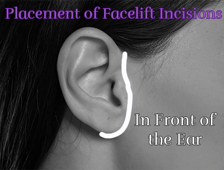 Where are facelift incisions?